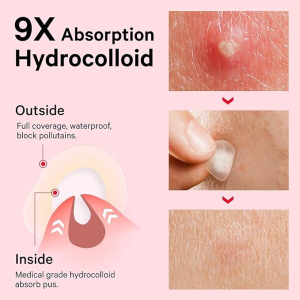 Sosky Pimple Patches for Face, FSA HSA Eligible Invisible Hydrocolloid Acne Patches, Zit Sticker for Face and Skin, Pimple Sticker for Covering Zits, Blemishes with Salicylic Acid 48 Count - Image 5
